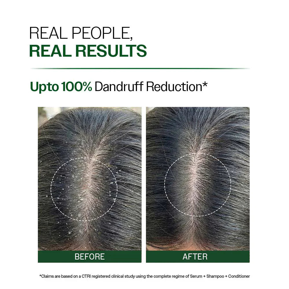 Hair Growth Serum (30 ml) &amp; Anti-Dandruff Shampoo (250 ml) Combo
